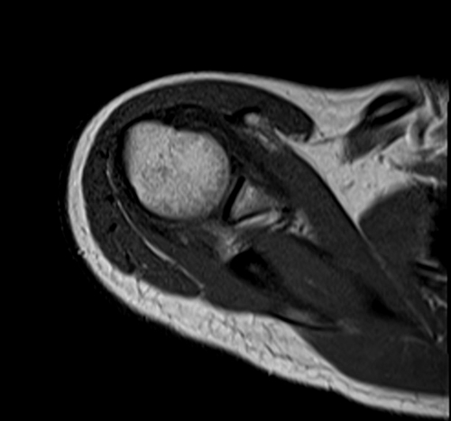 MRI humerus (upper arm) T1 axial images