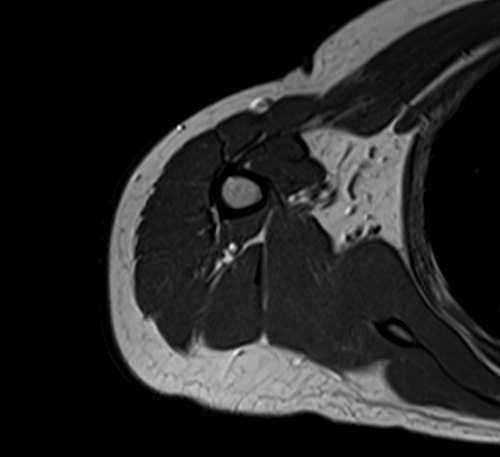 MRI humerus (upper arm) T1 axial images