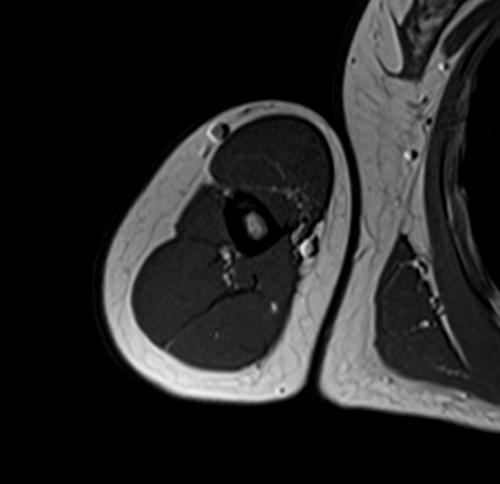 MRI humerus (upper arm) T1 axial images