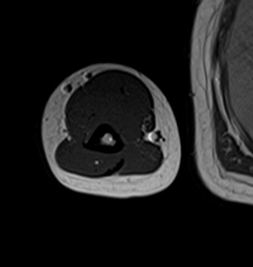 MRI humerus (upper arm) T1 axial images