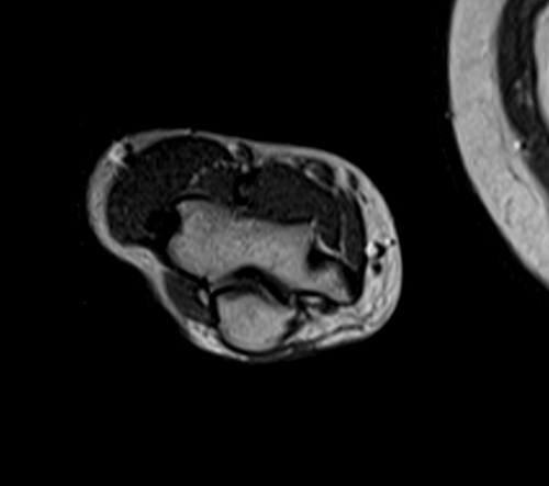 MRI humerus (upper arm) T1 axial images