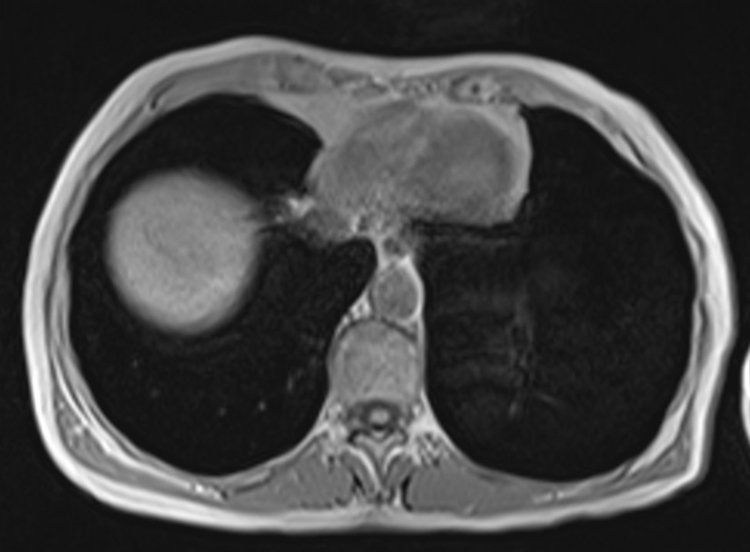 mri liver axial in phase image