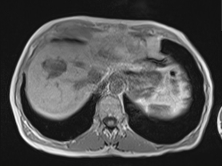 mri liver axial in phase image