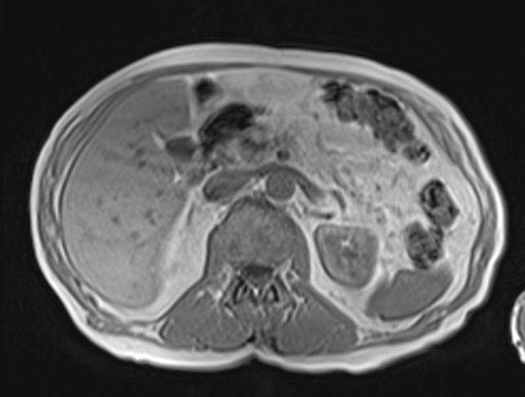 mri liver axial in phase image