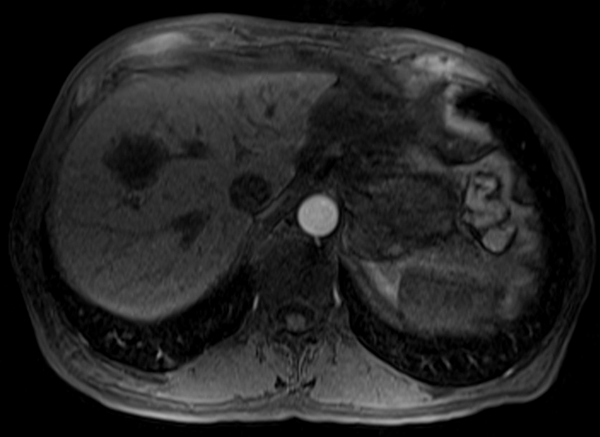 mri liver t1 post contrast arterial enhancement images