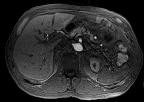 mri liver t1 post contrast arterial enhancement images