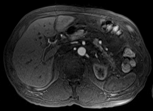 mri liver t1 post contrast arterial enhancement images