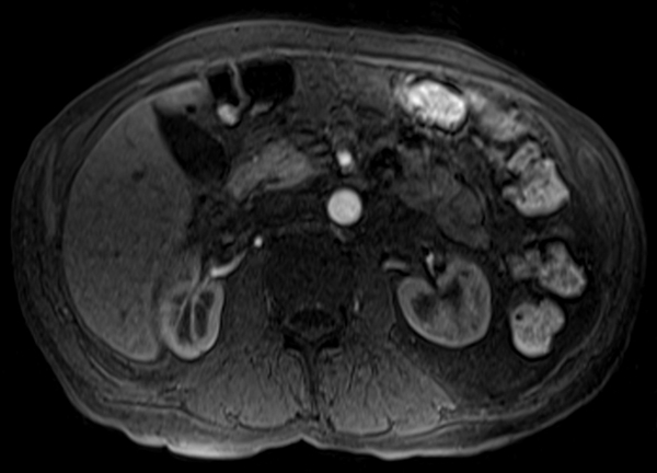 mri liver t1 post contrast arterial enhancement images