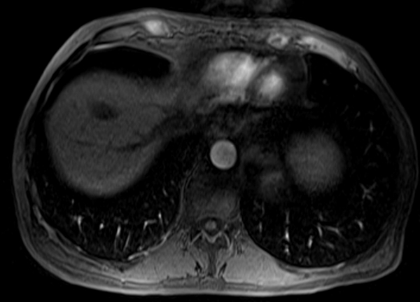 mri liver t1 post contrast arterial enhancement images