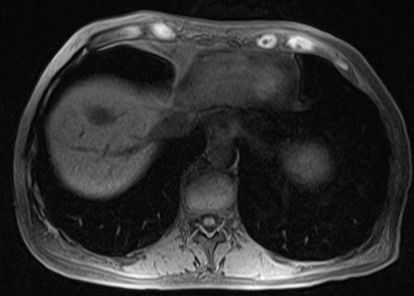 mri liver t1 flah pre contrast  image