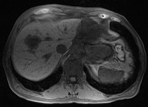 mri liver t1 flah pre contrast  image