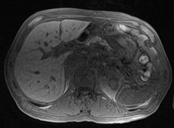 mri liver t1 flah pre contrast  image