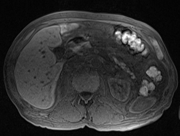 mri liver t1 flah pre contrast  image