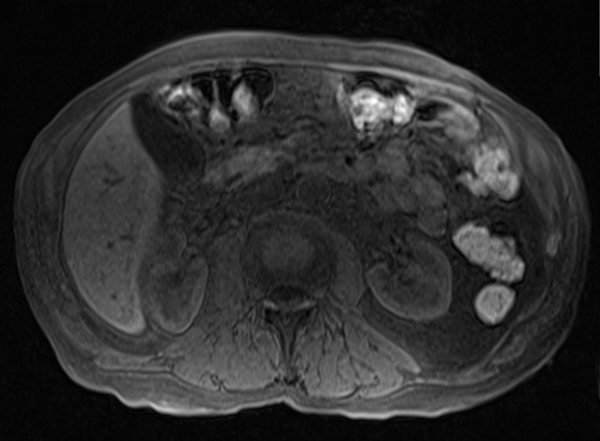 mri liver t1 flah pre contrast  image