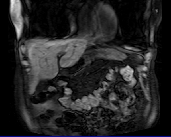 mri liver t1 flash coronal image