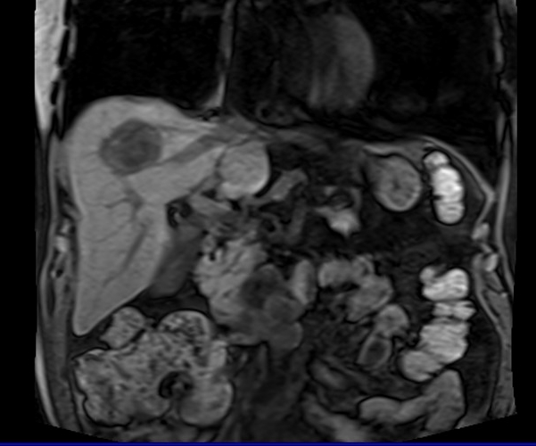 mri liver t1 flash coronal image