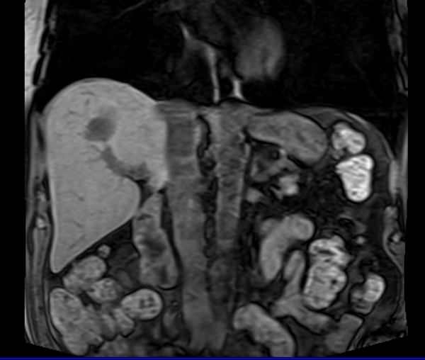 mri liver t1 flash coronal image