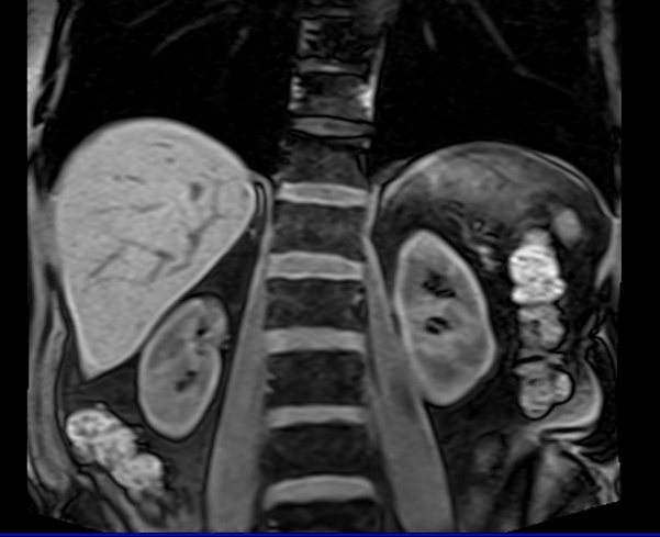 mri liver t1 flash coronal image