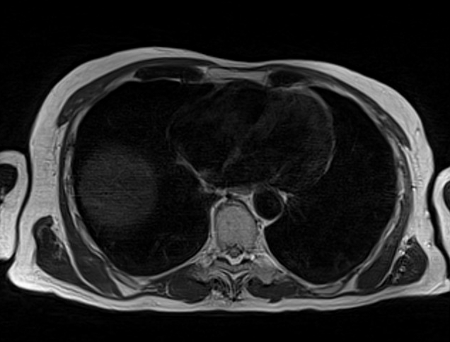 mri liver t2 tse gated axial images