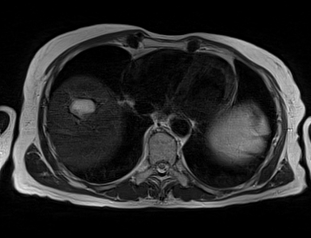 mri liver t2 tse gated axial images