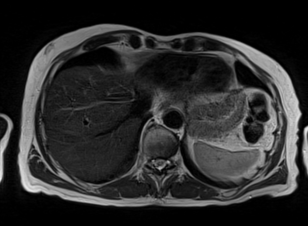 mri liver t2 tse gated axial images