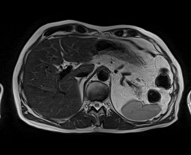 mri liver t2 tse gated axial images