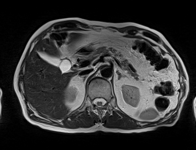 mri liver t2 tse gated axial images