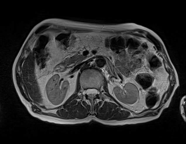 mri liver t2 tse gated axial images