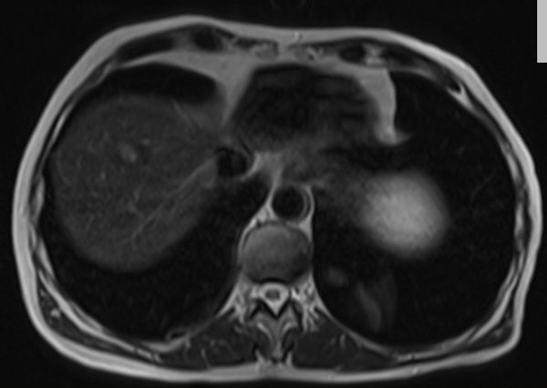 mri liver t2 tse TE 90  axial images