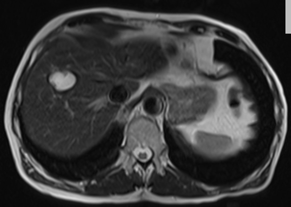 mri liver t2 tse TE 90  axial images