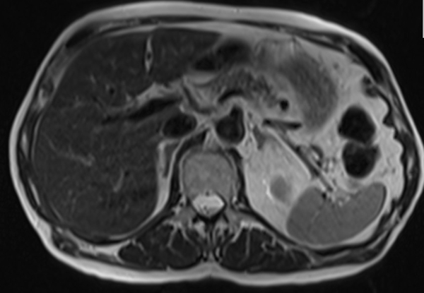 mri liver t2 tse TE 90  axial images