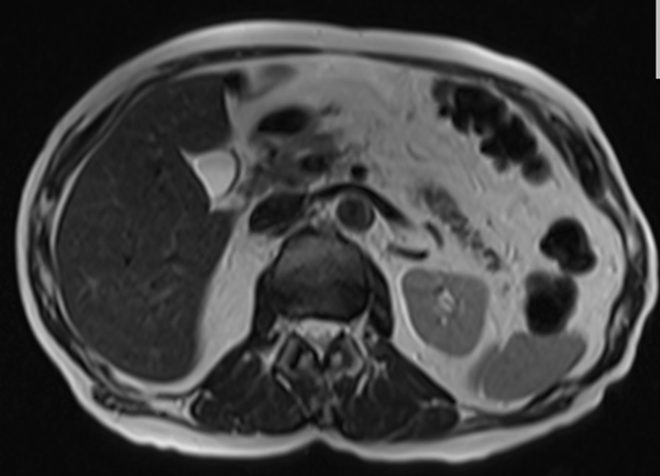 mri liver t2 tse TE 90  axial images