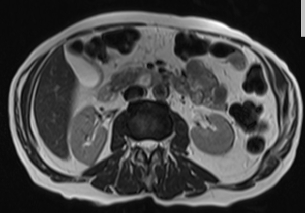 mri liver t2 tse TE 90  axial images