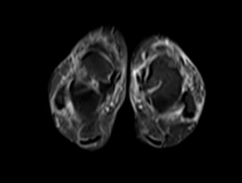 mri lower legs (calves)  stir axial image