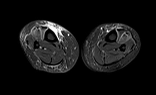 mri lower legs  (tibia and fibula)  stir axial image