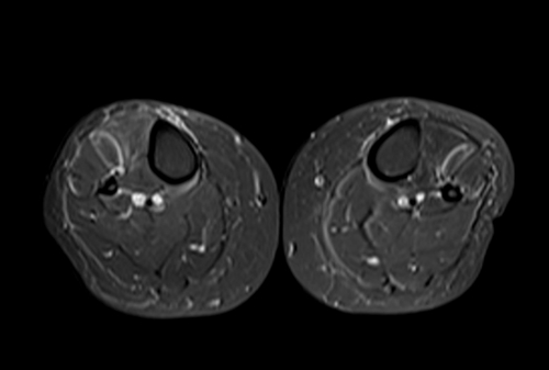 mri lower legs (calves)  stir axial image