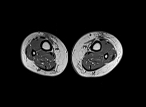 mri lower leg  (tibia and fibula) t1 axial image