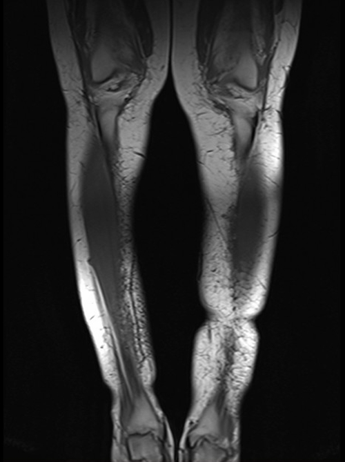 mri lower legs (calves)  t1 coronal image