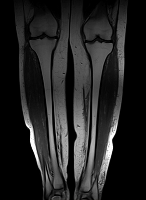 mri lower legs  (tibia and fibula)  t1 coronal image