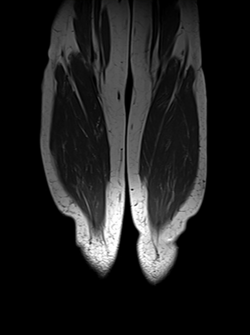 mri lower legs (calves)  t1 coronal image