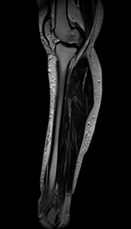 mri lower legs (calves)  t2 sagittall image