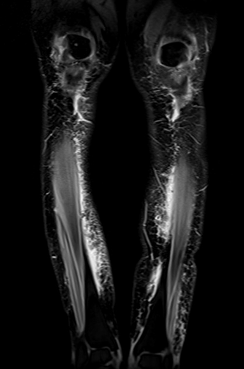 mri lower legs (calves) stir coronal image