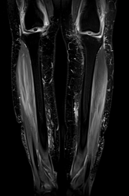 mri lower legs  (tibia and fibula) stir coronal image