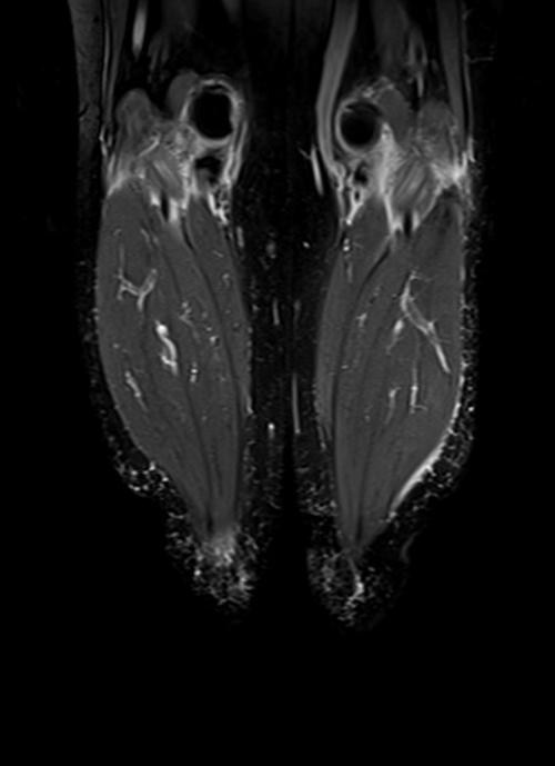 mri lower legs (calves) stir coronal image