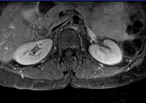 mri lumbosacral plexus axial t1 fat sat post contrast  image