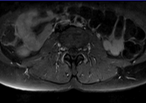 mri lumbosacral plexus axial t1 fat sat post contrast  image