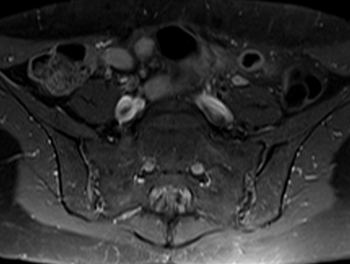 mri lumbosacral plexus axial t1 fat sat post contrast  image