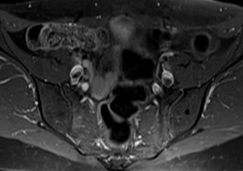 mri lumbosacral plexus axial t1 fat sat post contrast  image