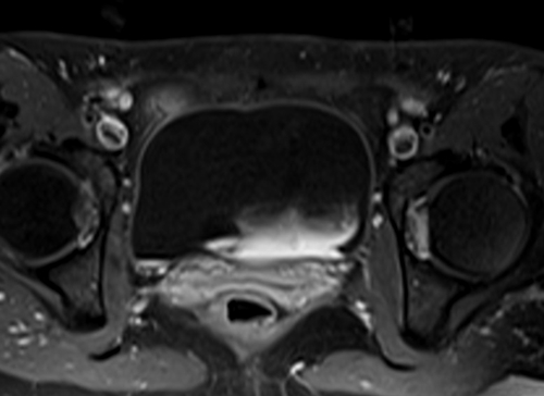 mri lumbosacral plexus axial t1 fat sat post contrast  image