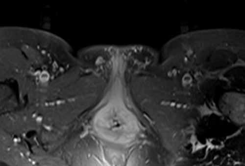 mri lumbosacral plexus axial t1 fat sat post contrast  image